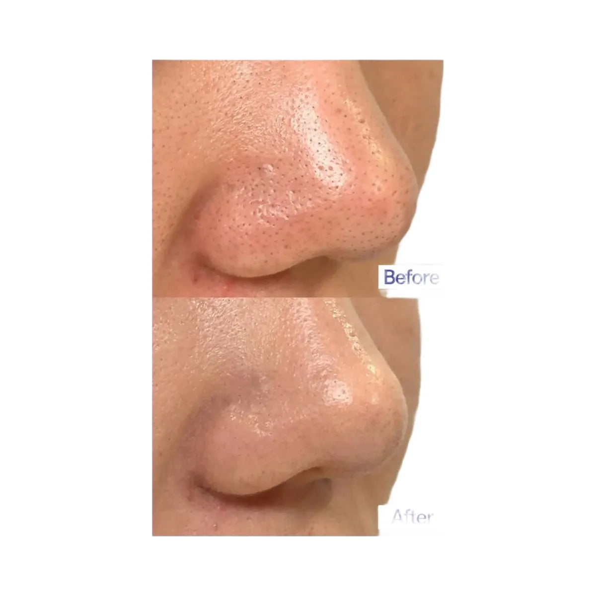 MEDIHEAL Blackhead Melting Clear Nose Patch