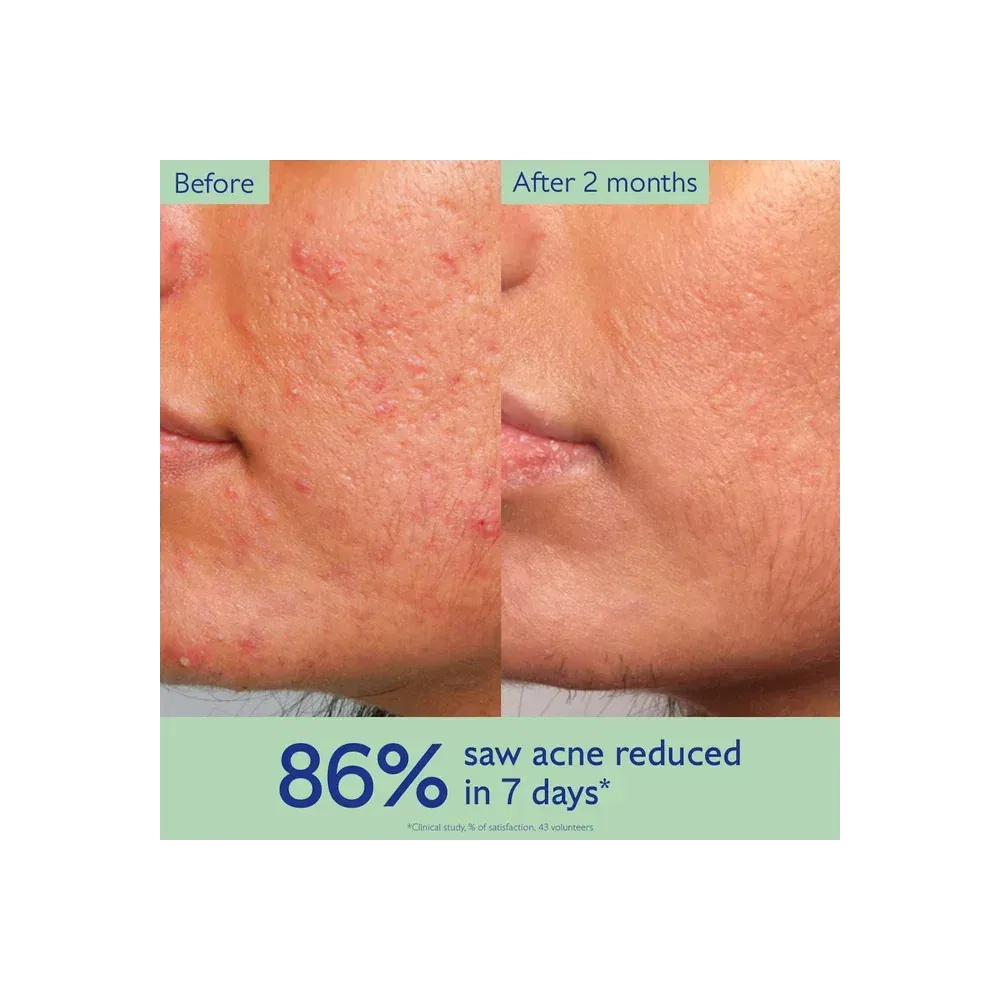 Caudalie Vinopure Acne Serum To Treat And Prevent Blemishes